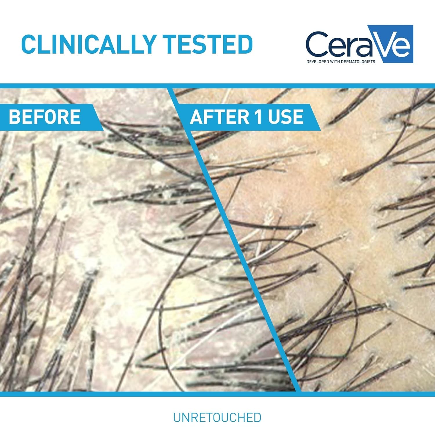 CeraVe anti dandruff shampoo before and after results, clinically tested, showcasing scalp improvement.