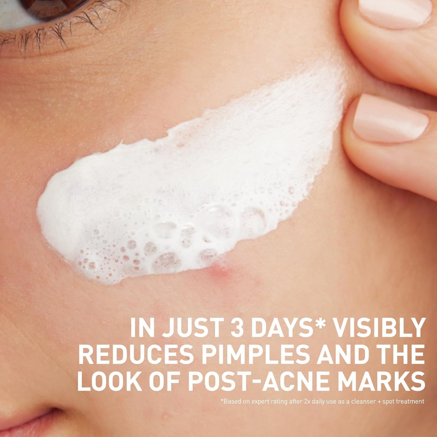 CeraVe salicylic acid acne face wash foaming cleanser on skin, targeting pimples and post-acne marks.