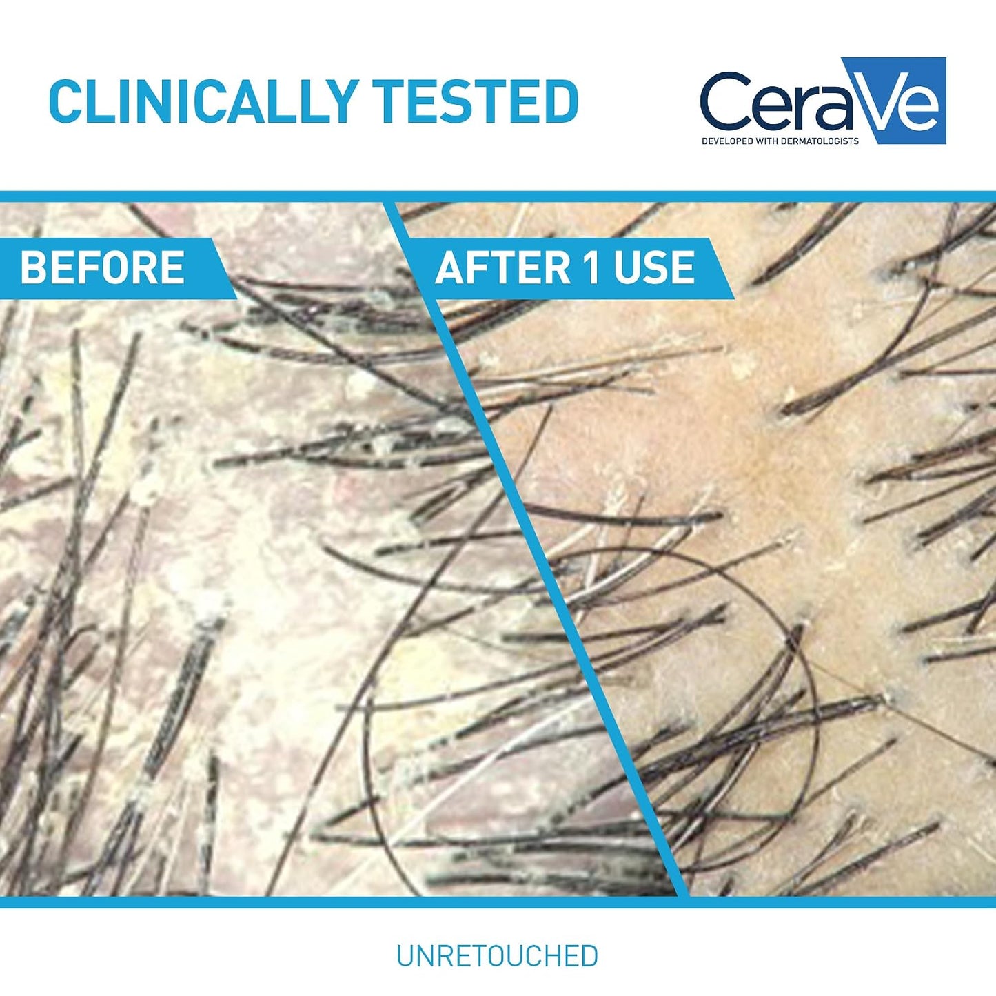 Before and after results of CeraVe anti dandruff shampoo and conditioner, clinically tested for effective dandruff elimination.
